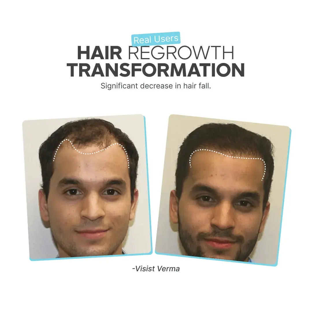 Hair Regrow Kit